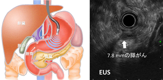 超音波内視鏡（EUS）による膵臓・胆道疾患の診断