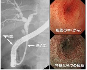 経口胆道・膵管鏡検査による診断イメージ