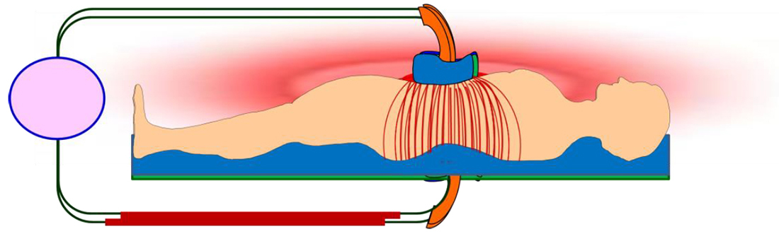 オンコサーミア治療イメージ図