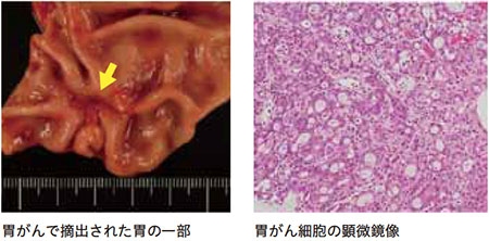 胃がんで摘出された胃の一部／胃がん細胞の顕微鏡像