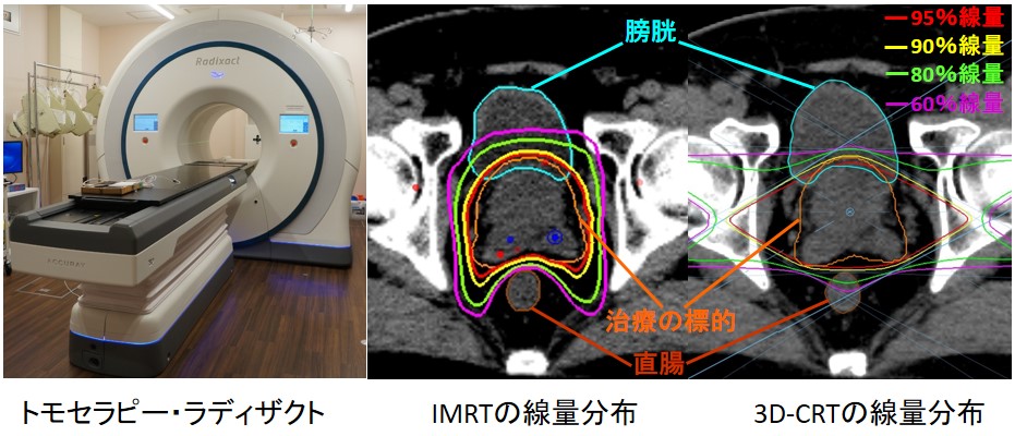 図：ラディザクトの外観と前立腺治療例の線量分布図の比較
IMRTでは照射野の形が標的に最適化されており、危険臓器の線量が低減されています。