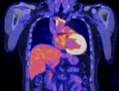 写真：高安動脈炎患者におけるPET-CTでの大動脈の異常集積