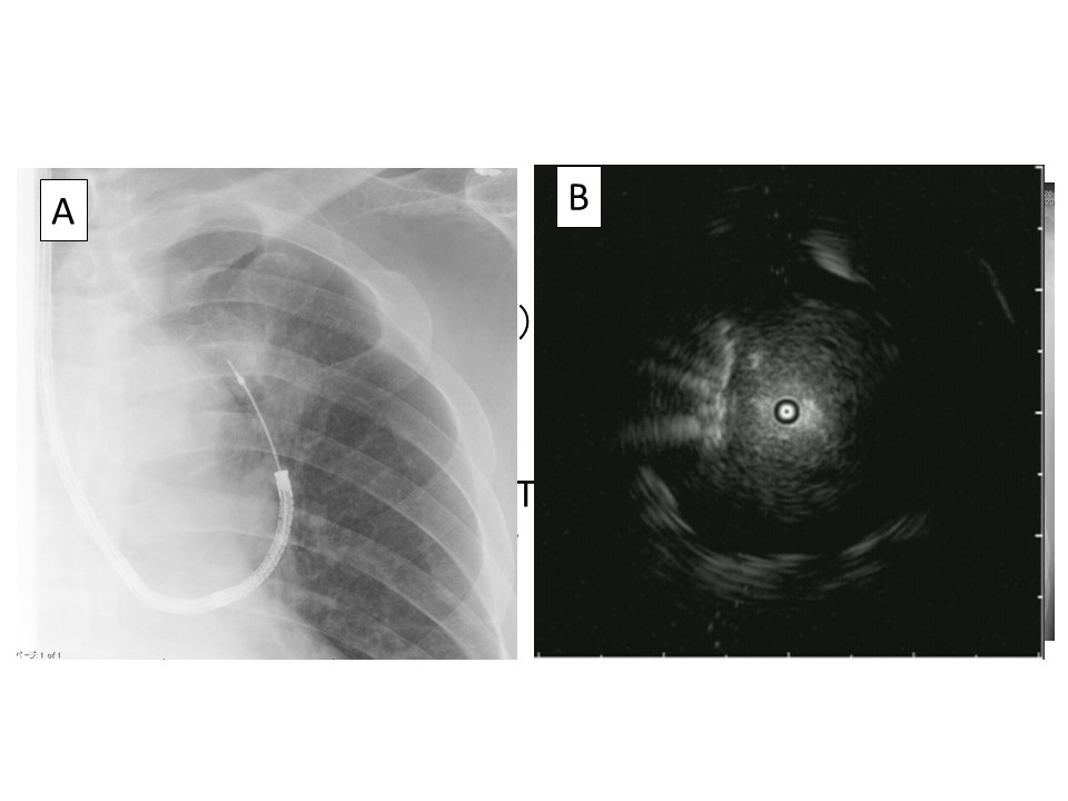 写真２： ガイドシース併用超音波気管支内視鏡
Aレントゲンで気管支鏡からつき出した道具が病変に到達しているか確認
B超音波気管支内視鏡で病変を確認