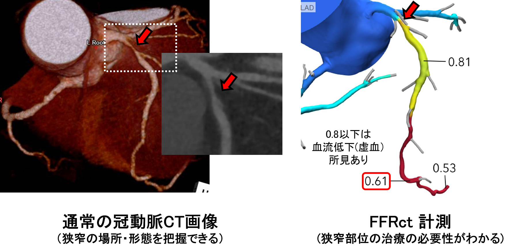 図２：冠動脈CT、FFR CT検査