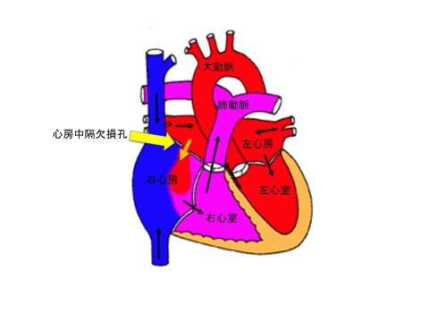 図１：心房中隔欠損症の心臓／欠損孔を通して左心房から右心房へのシャント血流を認めます。