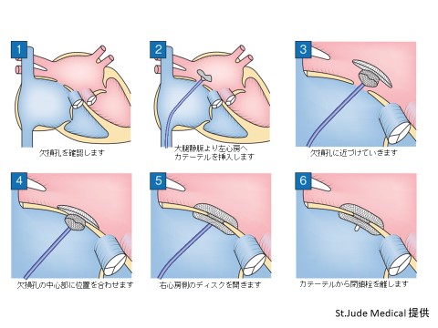 図２：カテーテル閉鎖術／右心房側からカテーテルを通して閉鎖栓を留置します。
