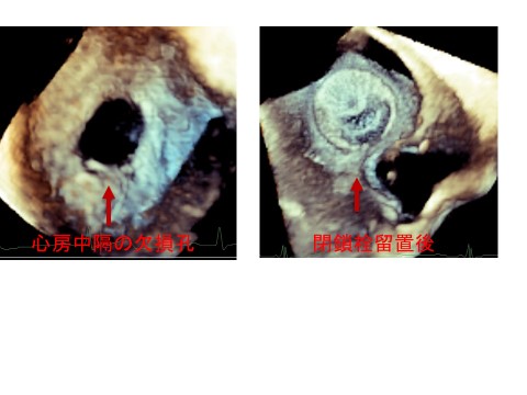 図３：3D心エコー画像／左は閉鎖前、右は閉鎖後です。