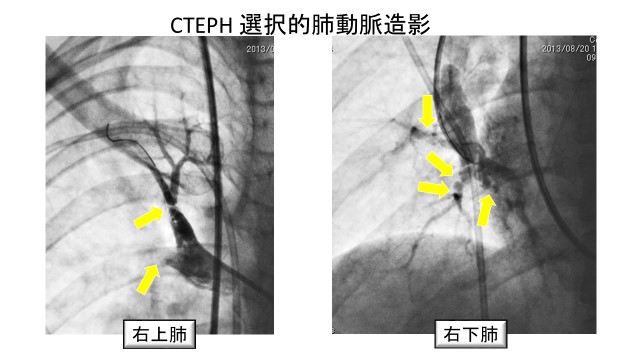写真１：肺動脈の狭い箇所や、詰まっている箇所を確認することができます。