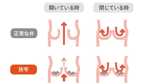 図２：大動脈弁狭窄症では、弁の開きが悪くなり血流が妨げられます