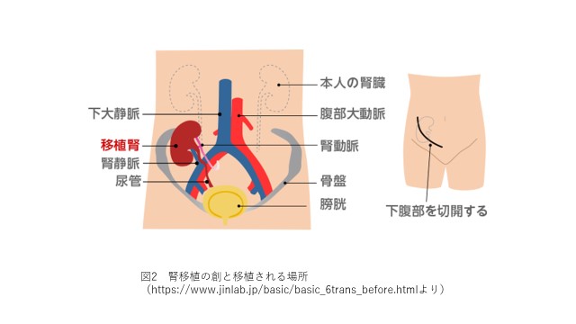 図２： 腎移植の創と移植される場所