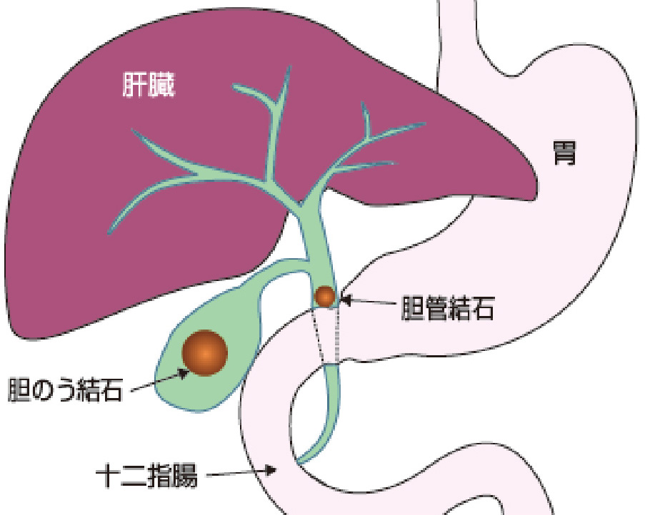 図１：胆石の種類
胆のうにある石が「胆嚢結石」、胆管にある石が「胆管結石」