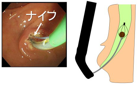 図２：胆管結石の内視鏡治療
胆管の出口をナイフで切開し広げ（左写真）、胆管の中の石をつかんで取り出します（右図）。