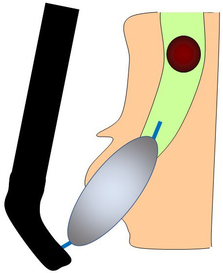 図３：大きな風船での胆管出口の拡張