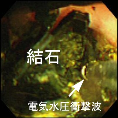 写真１－２：経口胆道鏡での結石破砕