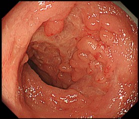写真２：クローン病(回腸)