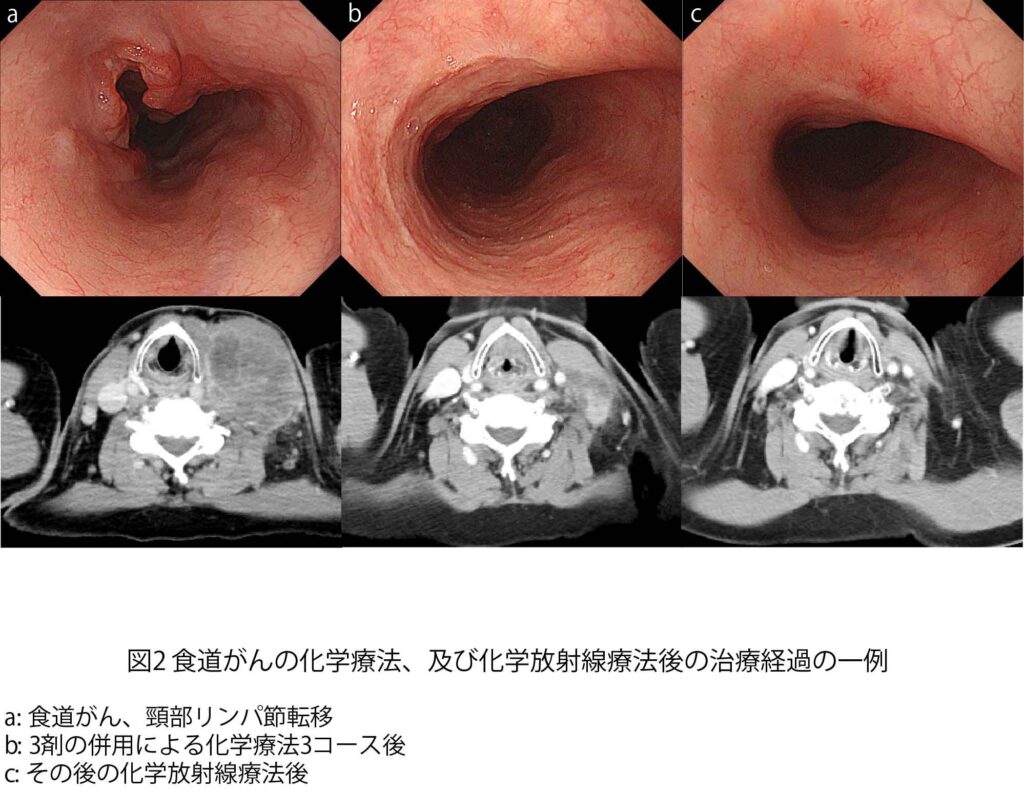図２： 食道がんの化学療法、及び化学放射線療法後の治療経過の一例