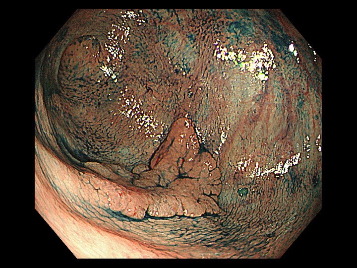 写真１b：早期大腸がんは内視鏡でも発見が難しく、症状は全くありません。