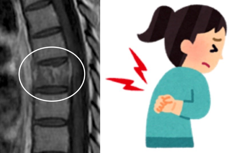図：悪性リンパ腫の治療後に発症した脊椎の圧迫骨折です。ひどい痛みで動けなくなりました。