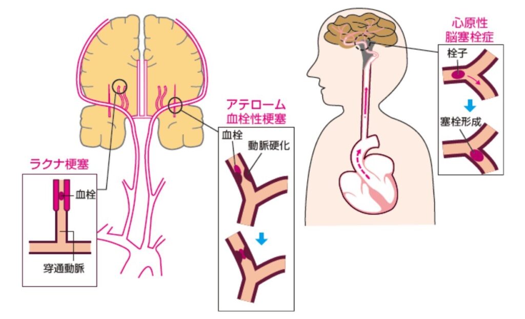 図１： 脳梗塞は、脳を栄養する血管が閉塞して、脳組織が傷害を受ける病気です。