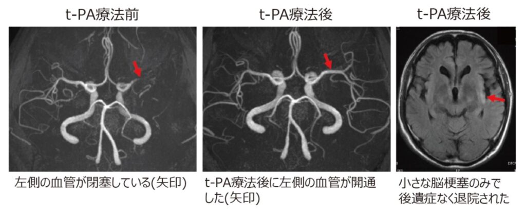 写真： rt-PA療法で閉塞した血管が開通し、劇的に改善することがあります。