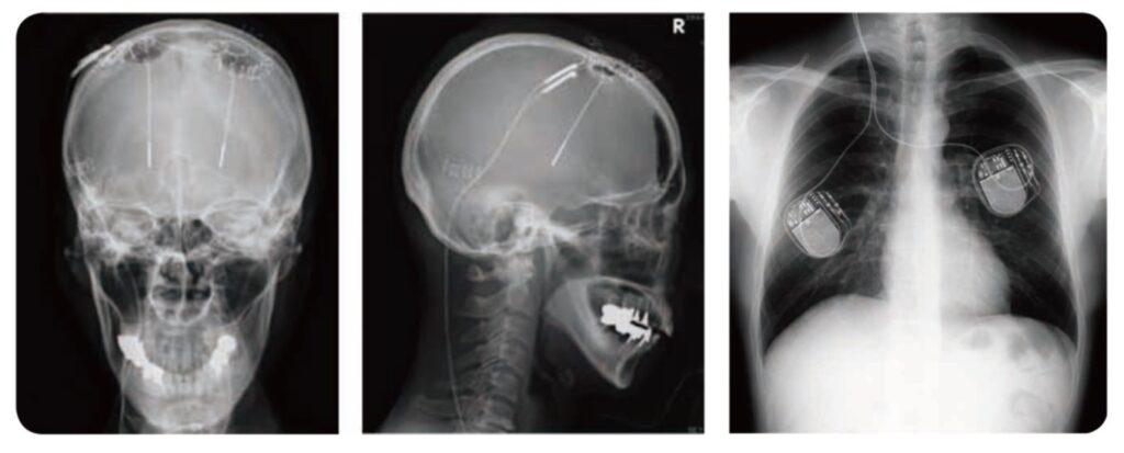 図２：脳深部刺激電極植込み術後のレントゲン写真