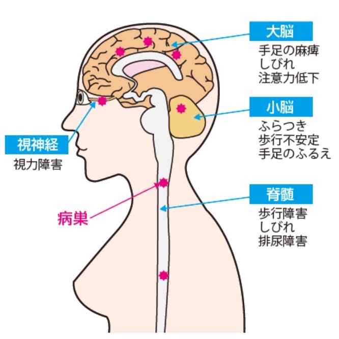 図１：大脳、小脳、脊髄、視神経に病巣ができ、さまざまな症状が出現します。
