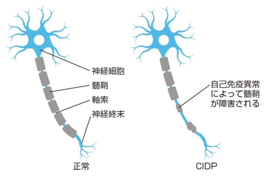 図２：CIDPは、末梢神経の髄鞘が障害（＝脱髄）される病気です。