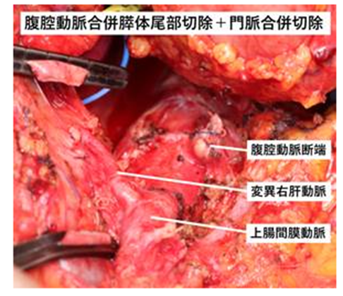 図２：腹腔動脈合併膵体尾部切除+門脈合併切除