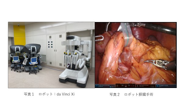 写真１：ロボット：da Vinci Xi、写真２：ロボット膵臓手術
