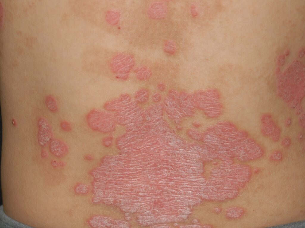 写真：乾癬の症状／腰部に落屑を付着する紅斑を多数認めます。