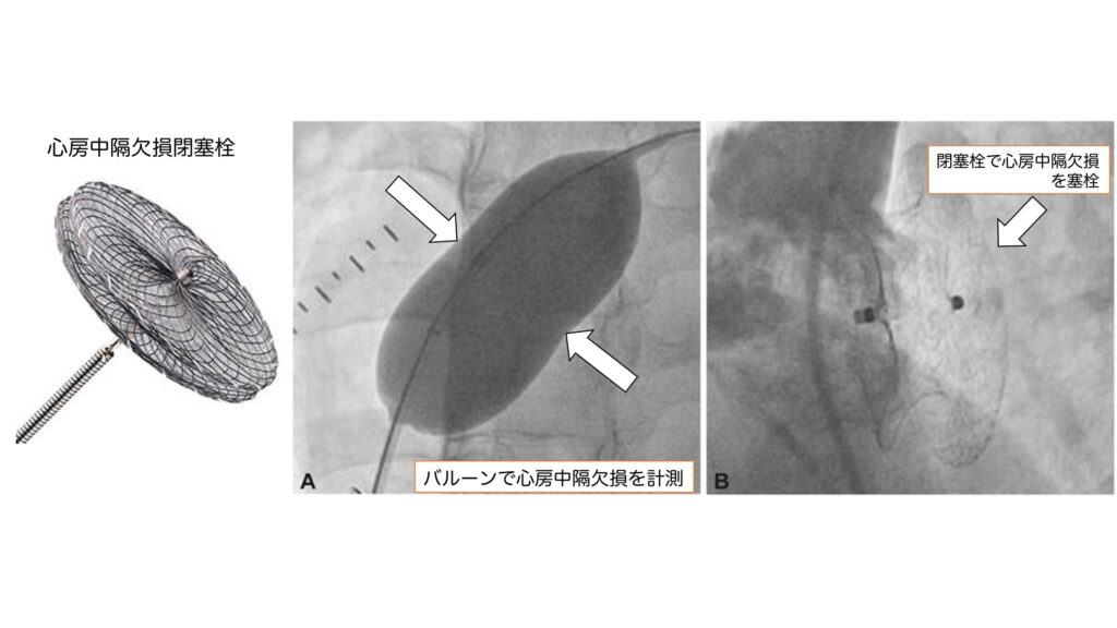 図２：経皮的心房中隔欠損閉塞術