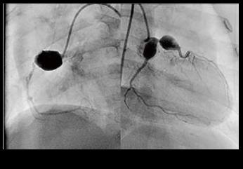 写真１：川崎病後の冠動脈瘤