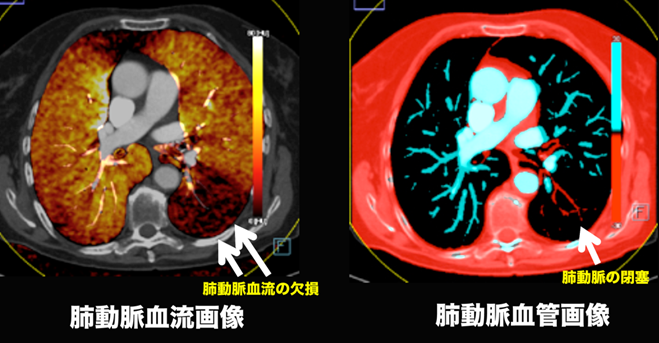 図４：肺動脈塞栓症（エコノミー症候群）