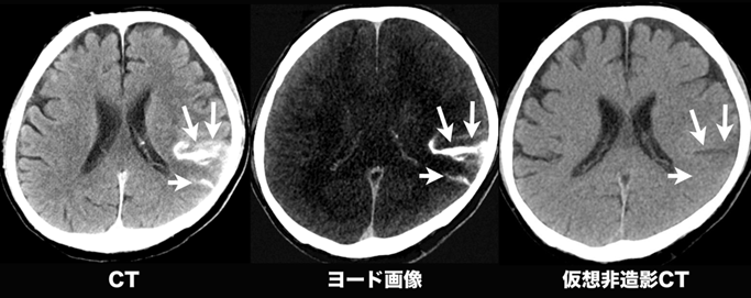 図５：急性期脳梗塞に対する血栓回収術後