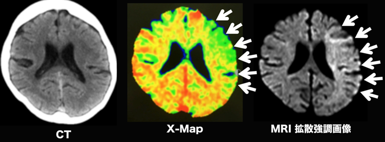 図６：発症0.5時間の急性期脳梗塞