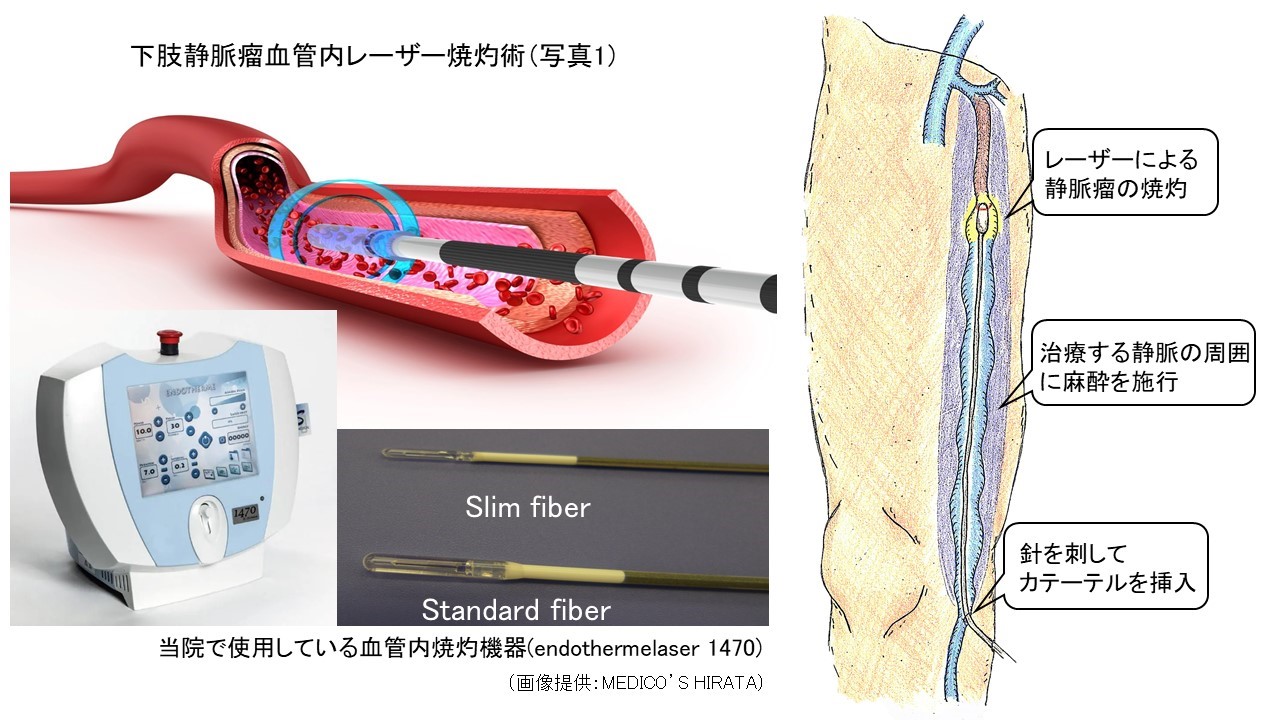 写真１：下肢静脈瘤に対するレーザー治療機器