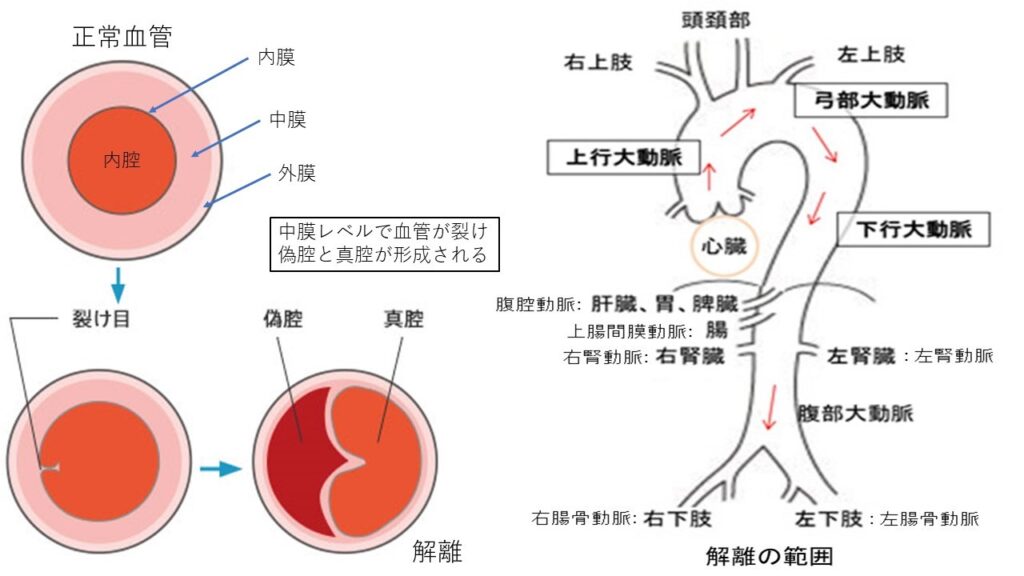 図１：大動脈解離の模式図