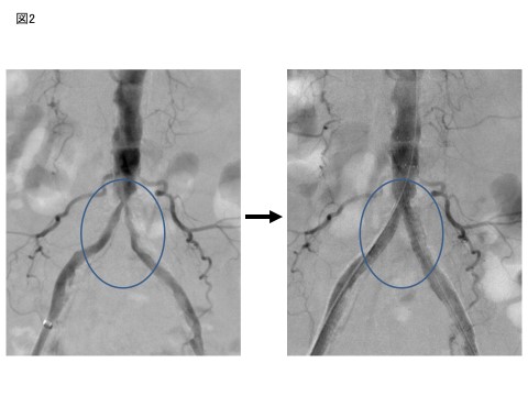図２：動脈の硬い部分を取り除き、そこから細い管を入れ、おなかの中の狭くなった動脈を金属の管（ステント）で広げています。