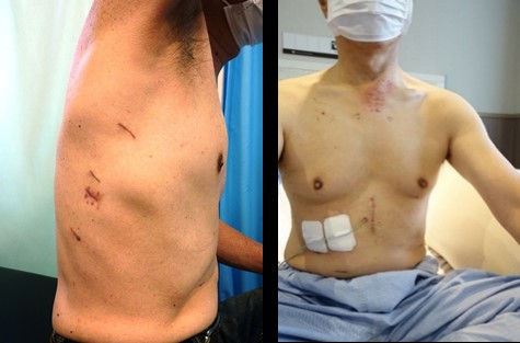 写真２：胸腔鏡下食道がん手術による傷