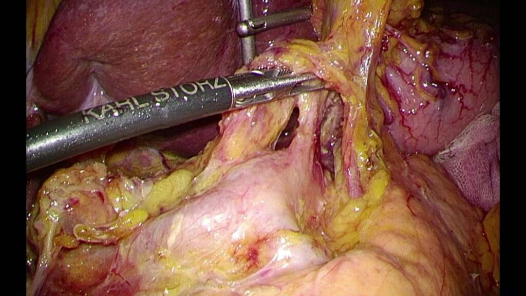 写真１：腹腔鏡手術画像(拡大視された血管解剖)