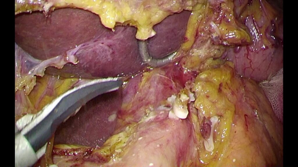 写真２：腹腔鏡手術画像(拡大視された血管解剖)