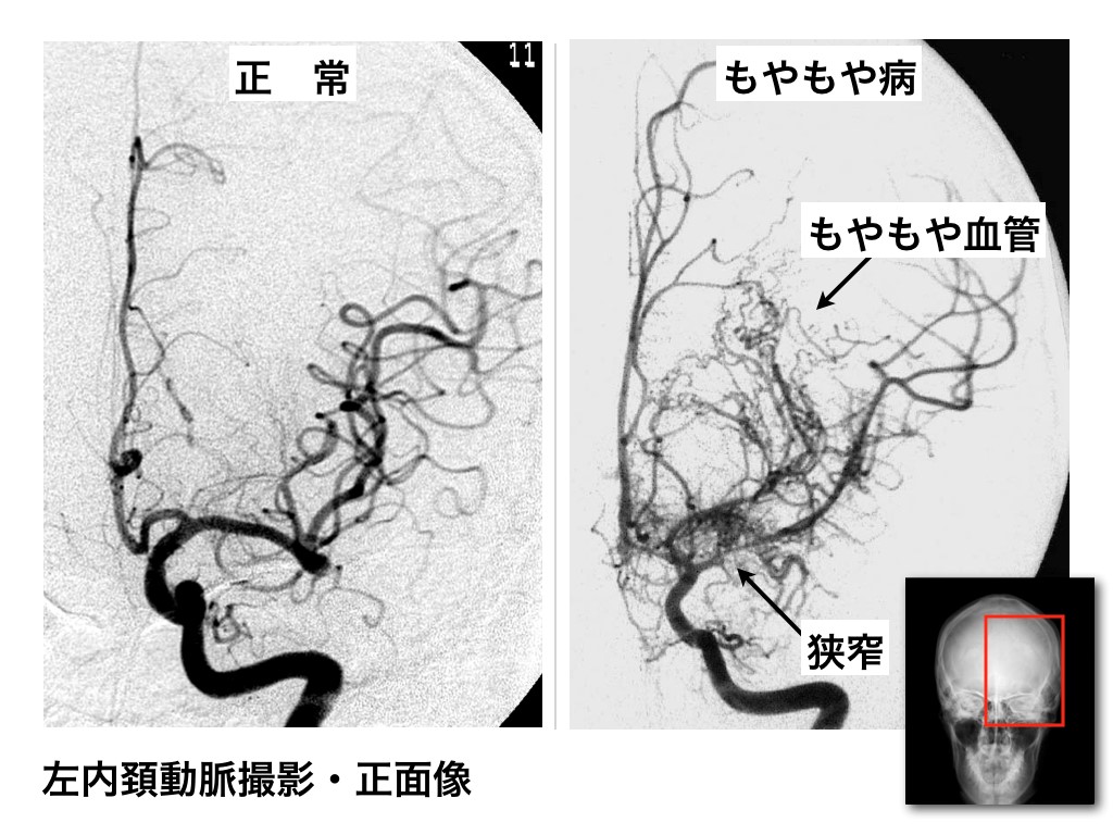 図１：正常（左）、もやもや病（右）の脳血管撮影