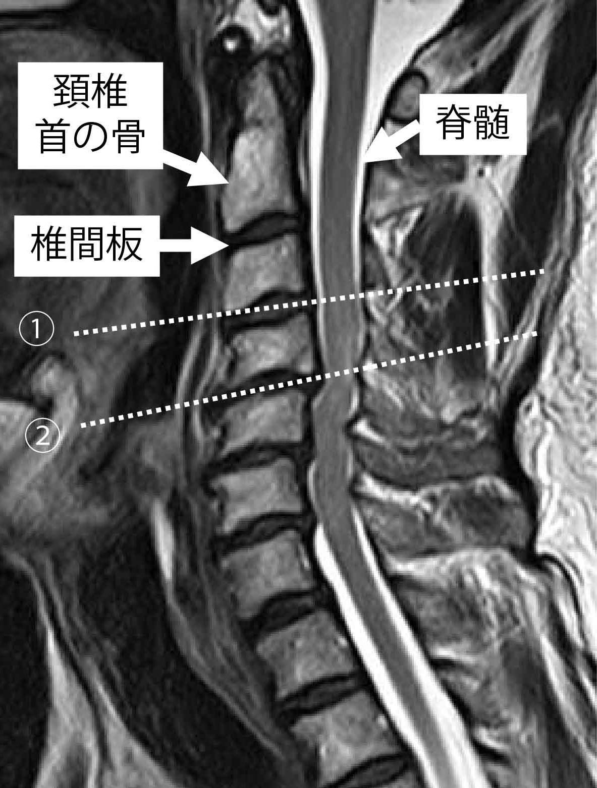 図１：頚椎（首）を横から見たMRI。①の部分では脊髄の圧迫はない状態です。②の部分では脊髄が蛇行しているように見え、圧迫が起こっている状態です。