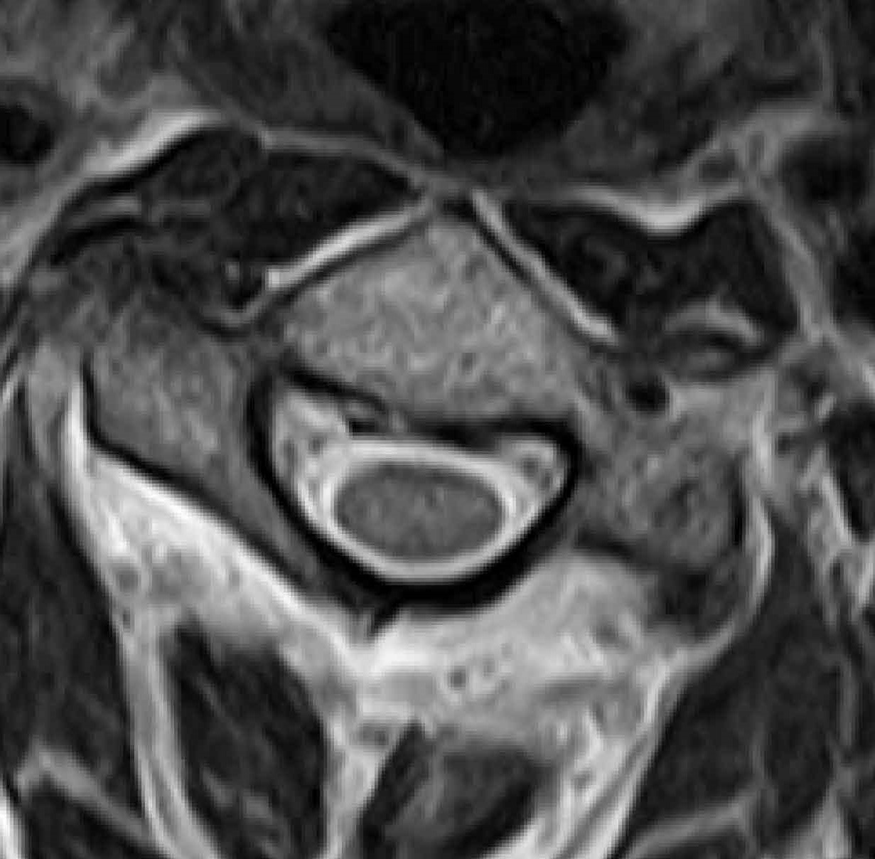 図２：図1-①で頚椎（首）の輪切りを切ったMRI。脊髄は楕円形をしており、周りから圧迫は受けていません。