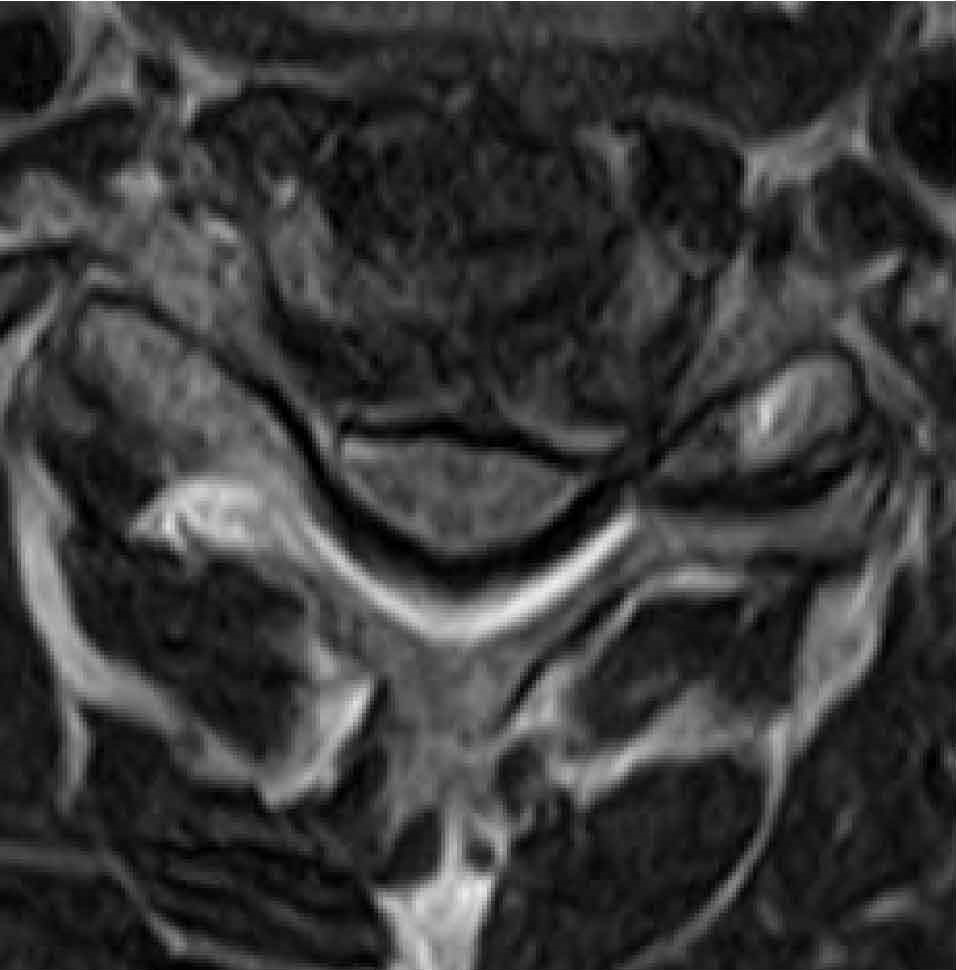 図３：図1-②で頚椎（首）の輪切りを切ったMRI。脊髄は三角形をしており、周りから圧迫を受けています。
