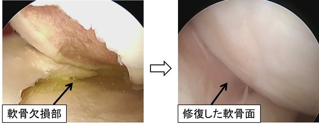 写真１：軟骨欠損部（左）に骨軟骨柱を移植し、術後約1年で軟骨面が修復したところです（右）。