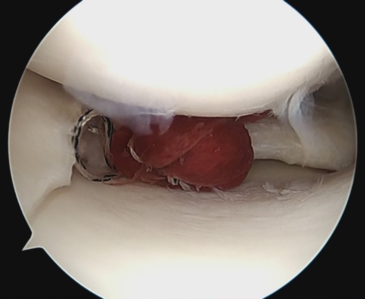 写真３：膝関節鏡の画像。半月損傷部に血餅を充てんし、半月板縫合を行っているところです。