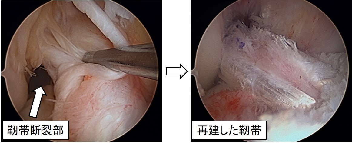 写真４：断裂した前十字靭帯（左）に対し、関節鏡で靭帯再建術を行います（右）。