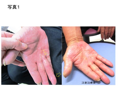 写真１：デュピイトレン拘縮（手のひらに索状のしこりができて、指が伸ばせなくなる疾患）。