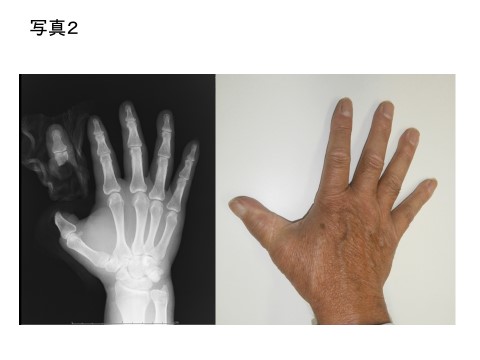写真２：母指の完全切断、切断指の再接着の手術後。顕微鏡で血管や神経をつなぎます。